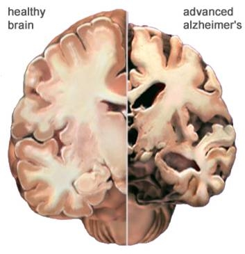 dementia cause death does affect leading currently brain eventually kill actually