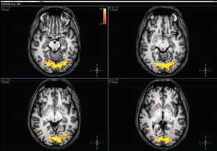 Functional MRI Study